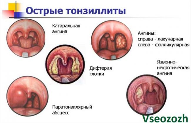 Течение и лечение лакунарной ангины
