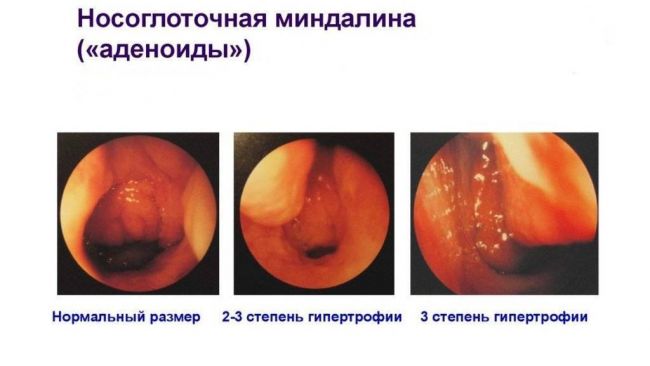 Аденоиды у ребенка признаки симптомы лечение