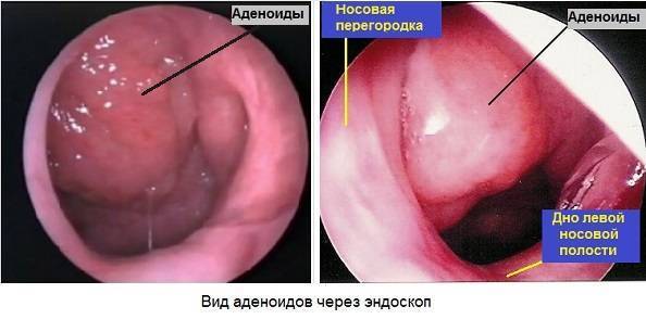 Аденоиды у ребенка признаки симптомы лечение