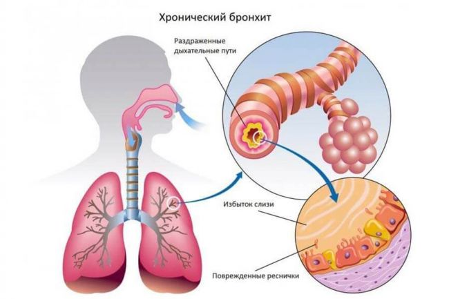 Хронический астматический бронхит: симптомы и лечение