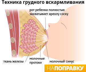 Симптомы мастита