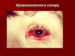 Кровоизлияние в глаз: что делать, причины и лечение, симптомы, диагностика