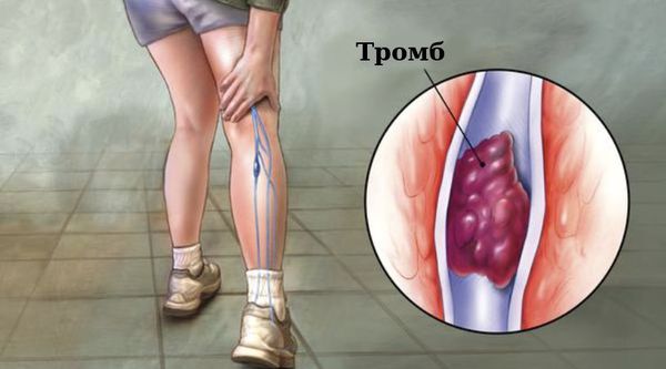 Тромбы: от чего образуются? механизмы образования и виды тромбов