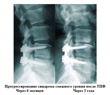 Спондилодез позвоночника, в том числе задний, передний: что это такое, особенности в шейном и других отделах