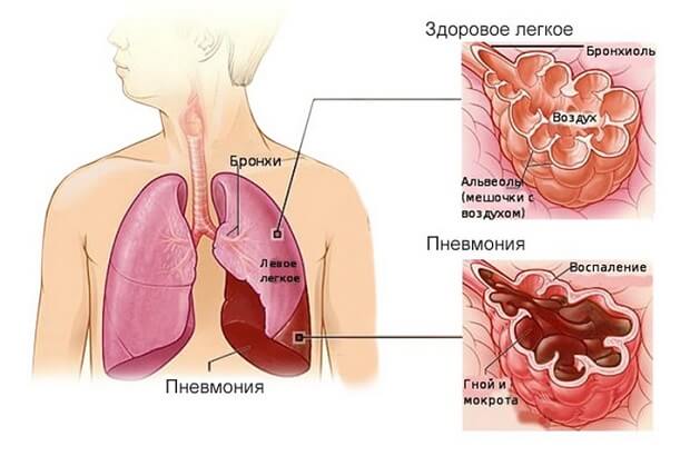 Может ли быть воспаление легких без температуры и кашля, особенности лечения