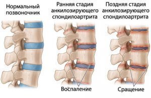 Анкилозирующий спондилит - симптомы, лечение, классификация, диагностика