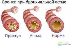 Причины и механизм развития приступа астмы, симптомы, первая помощь, лечение