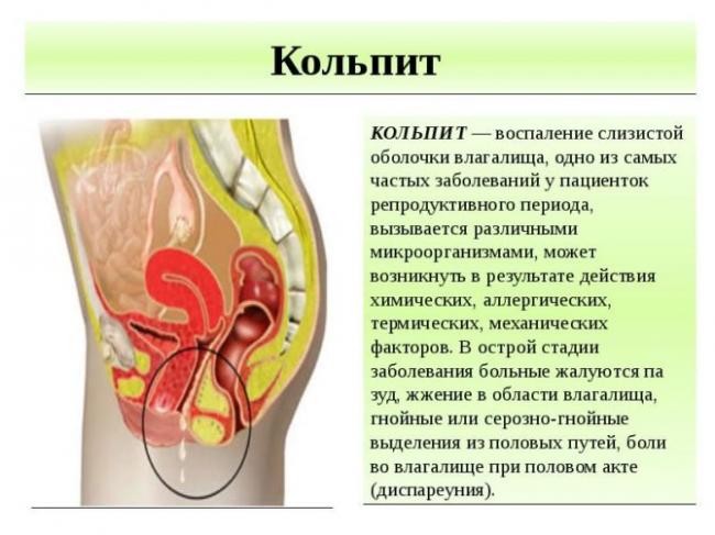 Кольпит: причины, симптомы, диагностика и лечение