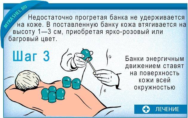 Банки на позвоночник: противопоказания