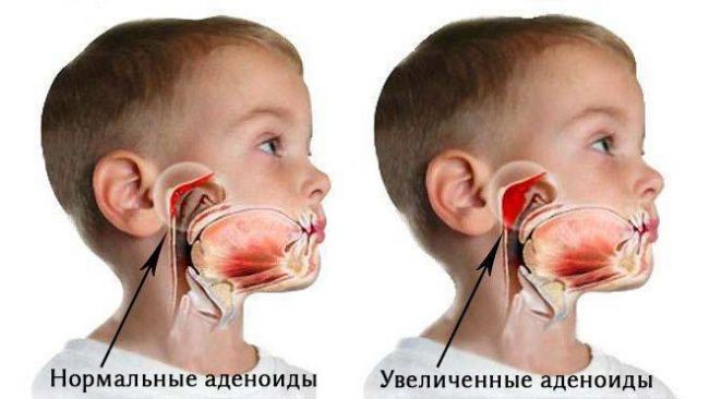Ложный круп у детей: симптомы, лечение и первая помощь в домашних условиях