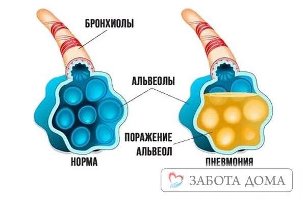 Пневмония у лежачих больных: причины, симптомы, лечение