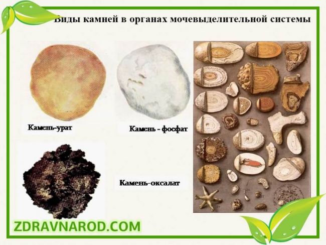 Если болят почки симптомы и лечение народными средствами