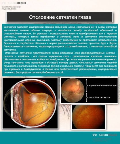 Деструкция стекловидного тела