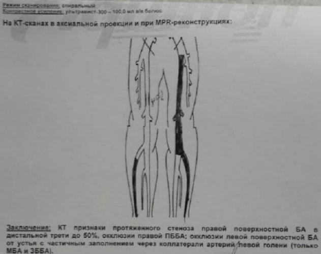 Важная сонная артерия и ее характеристики