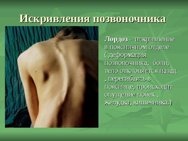 Как делается рентген пояснично крестцового отдела позвоночника