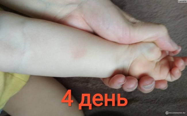 Как определение размера манту у ребенка в 3 года указывает на норму и может сохранить его здоровье?