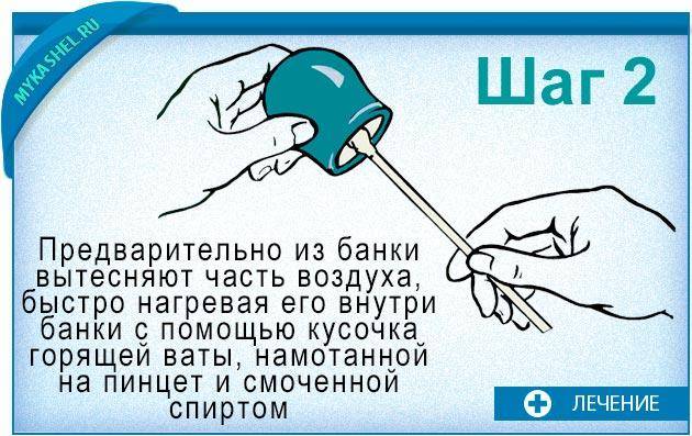 Банки на позвоночник: противопоказания