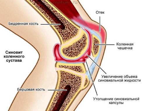 Синовит сустава (коленный, тазобедренный, голеностопный, локтевой, лучезапястный и др.) - причины, симптомы, диагностика и лечение, народные средства