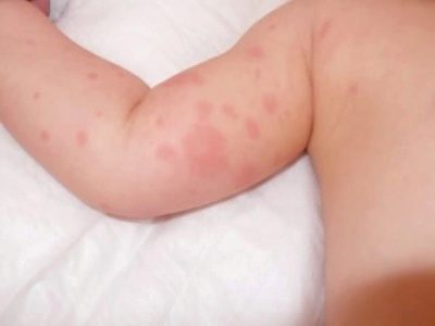 Шелушение кожи у новорожденных