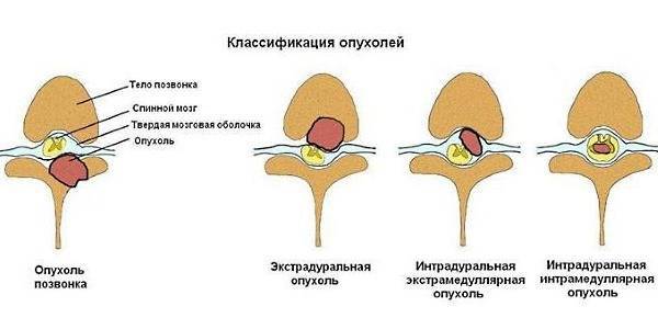 Как распознать рак позвоночника симптомы