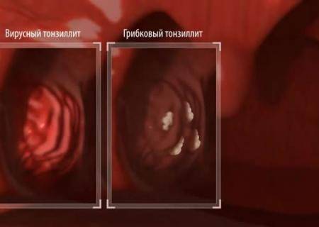 Фурацилин для горла инструкция по применению