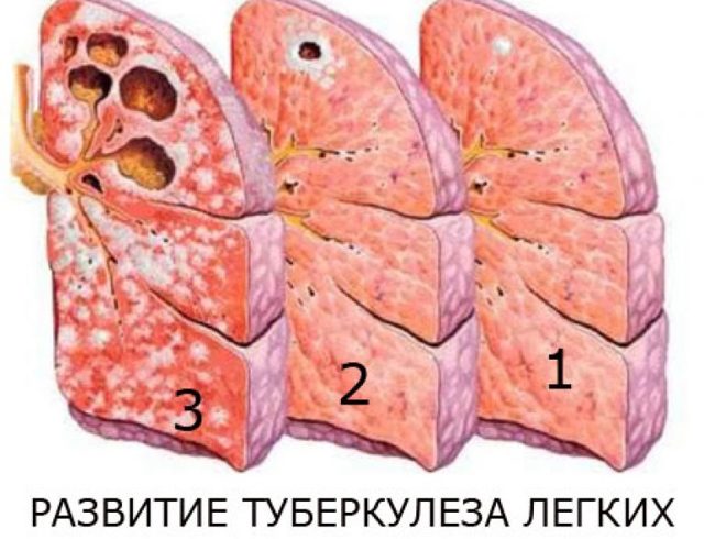 Детский туберкулез: основные признаки, лечение и профилактика