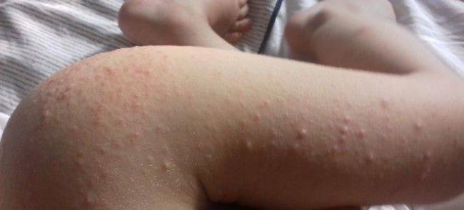 Сыпь на голове у грудного ребенка причины