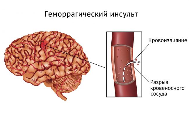 Пневмония при инсульте и после него: причины, последствия, профилактика