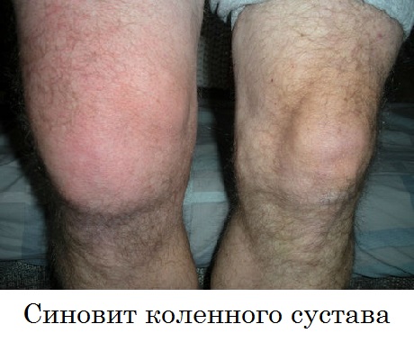 Чем опасен синовит коленного сустава? причины, симптомы, последствия патологии. методы лечения