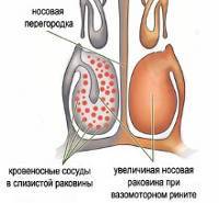 Как можно самостоятельно вылечить вазомоторный ринит народными средствами