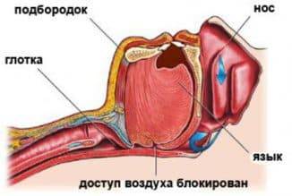 Почему человек храпит во сне, как вылечить храп медикаментозно, народными средствами