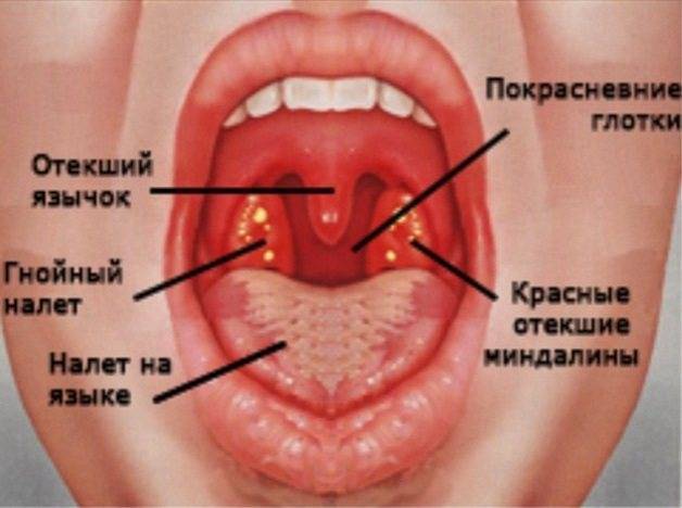 Как избавиться от гнойных пробок в горле, их причины