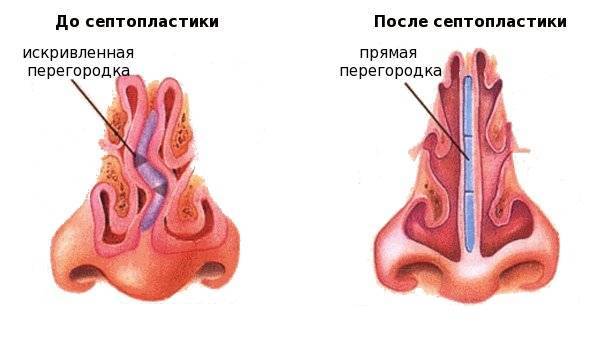 Воспаление после операций в полости носа и околоносовых пазухах: необходимость медикаментозного регулирования