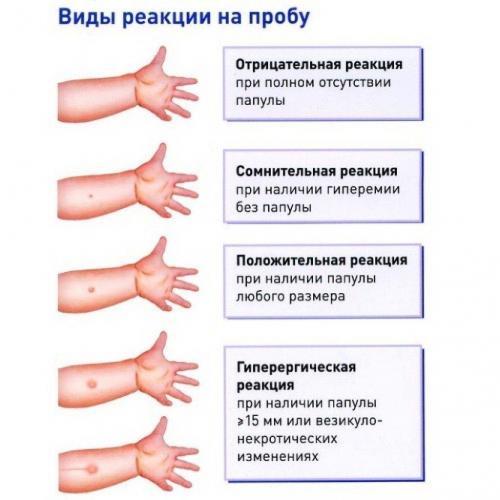 Что нужно знать о манту у ребенка в 2 года: какова норма?