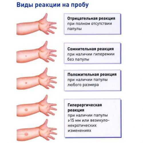 Когда нельзя делать манту: противопоказания