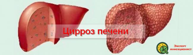 Степени и лечение фиброза печени