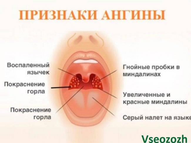 Лечение герпесной ангины у детей. народные средства, антибиотики. виды, симптомы, последствия