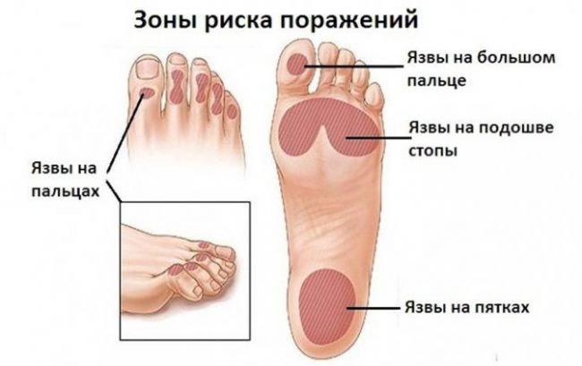 Диабетическая полинейропатия