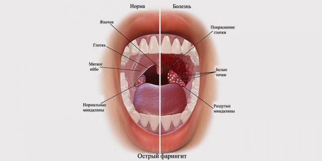 Как самостоятельно избавиться от пробок в горле
