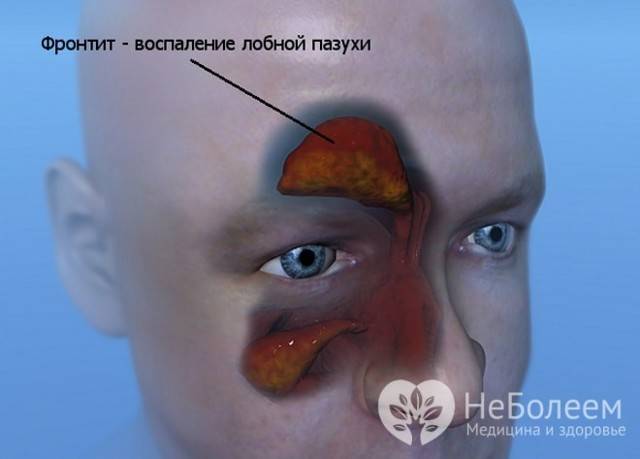 Как лечить левосторонний (правосторонний) гайморит?