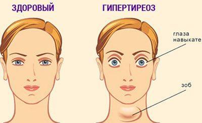 Фостер (foster)