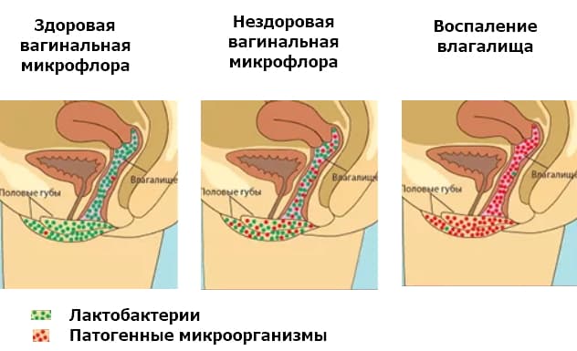 Дисбактериоз влагалища, его причины, симптомы и лечение
