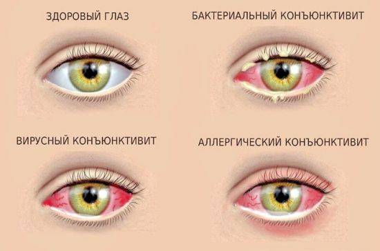 Почему у ребенка красные глаза и что делать?