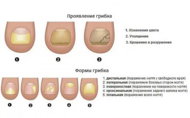 Грибок на руках: руководство по типам и борьбе