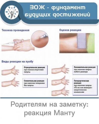 Как определение размера манту у ребенка в 3 года указывает на норму и может сохранить его здоровье?