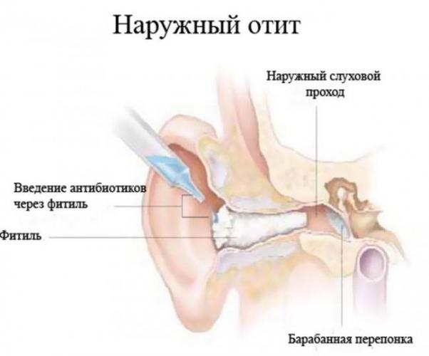 Обзор популярных антибиотиков при отите