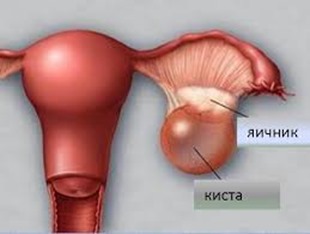 Что такое киста и какая она бывает?