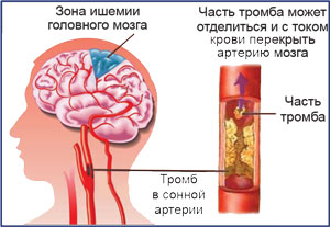 Закупорка сонной артерии: симптомы и лечение