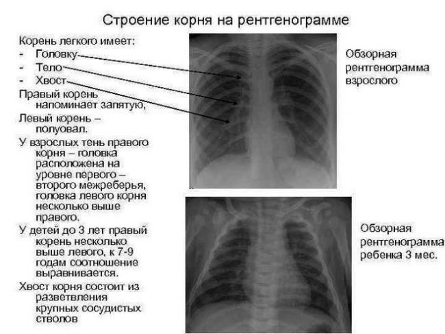 Может ли рентген не показать пневмонию?