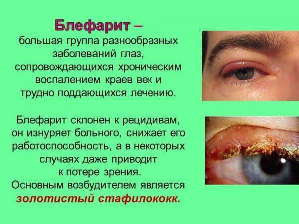 Тетрациклиновая глазная мазь: инструкция по применению для детей и взрослых, как наносить тетрациклиновую мазь для глаз